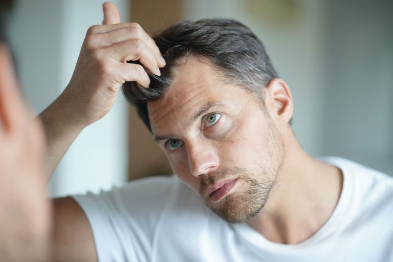 Common Signs and Causes of Balding and Hair Loss in Men and Women