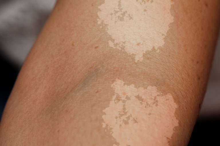 Common Causes of Skin Discoloration